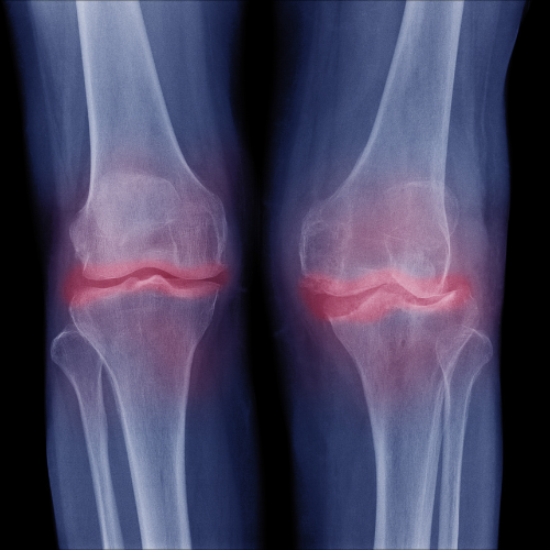 revalidatie na nieuwe knie Vief Leven